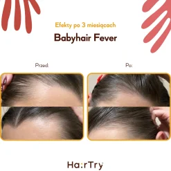 HairTry - Babyhair Fever - Wcierka Rozgrzewająca na Porost Włosów - 100ml
