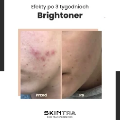SkinTra - Brightoner - Całoroczny Tonik Kwasowy 9% - 100ml