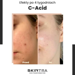SkinTra - C-Acid - Kwasowa Kuracja z Witaminą C - 30ml