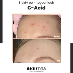 SkinTra - C-Acid - Kwasowa Kuracja z Witaminą C - 30ml